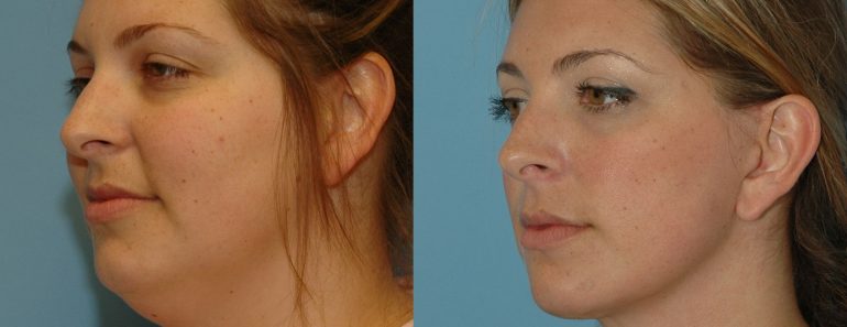 Multiple Ways On How To Lose Face Fat? Multiple Ways On How To Lose Face Fat?