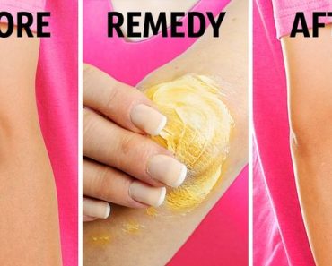 How To Remove Dark Knees And Elbow Naturally?