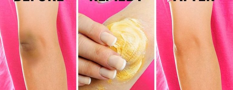 How To Remove Dark Knees And Elbow Naturally?