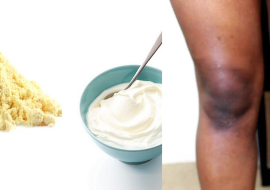 Remove Dark Knees And Elbow Naturally With Curd