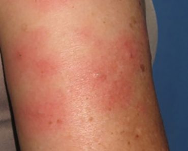 How to handle ulcerative colitis rash?