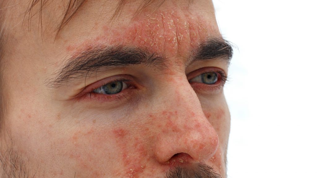 psoriasis on face