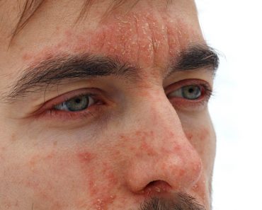 Wonder about potential cause & treatment about Psoriasis on face