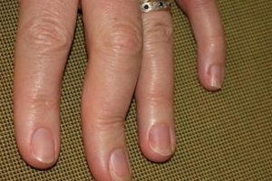 Potential symptoms, causes & treatment for Psoriatic arthritis