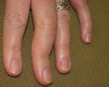 Potential symptoms, causes & treatment for Psoriatic arthritis