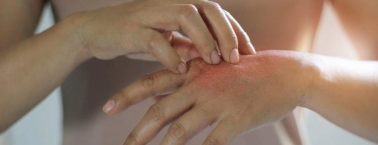 Top 6 Naturopathy treatment for Psoriasis